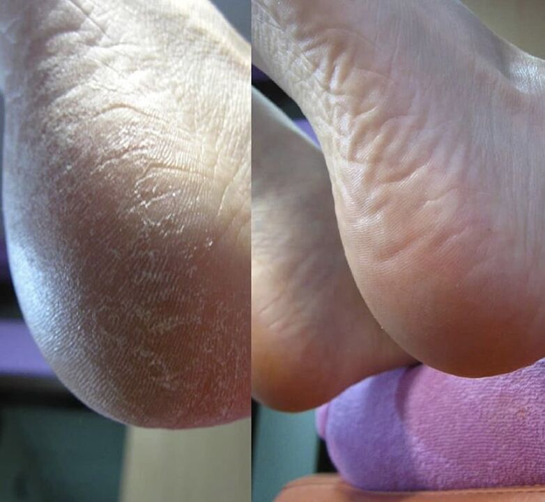 Foto do calcanhar do pé antes e depois de usar o creme Zenidol