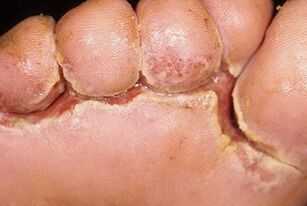 sintomas de fungos nas unhas dos pés