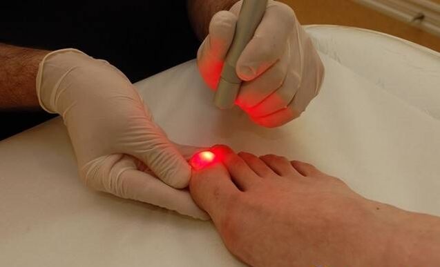 tratamento a laser para fungos nas unhas
