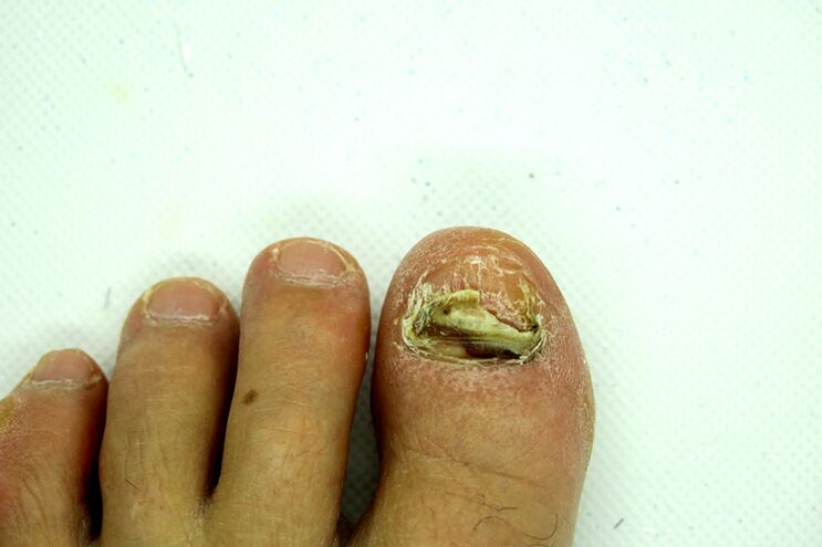 Fungo das unhas de dedos - palco pesado