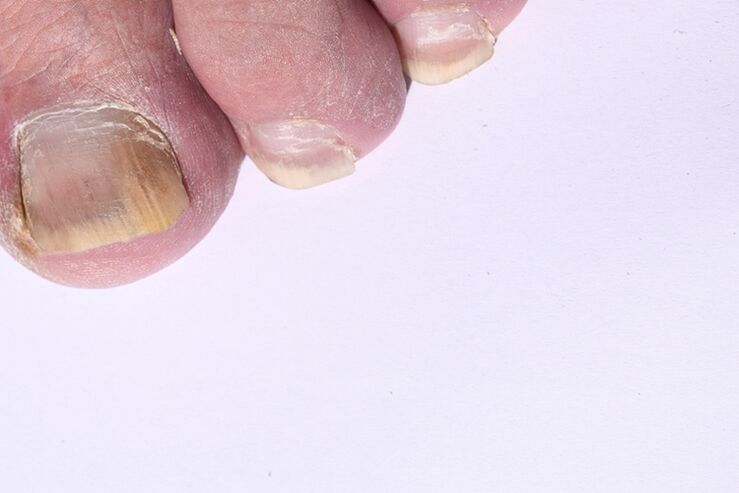 O estágio inicial da micose de unhas nas pernas