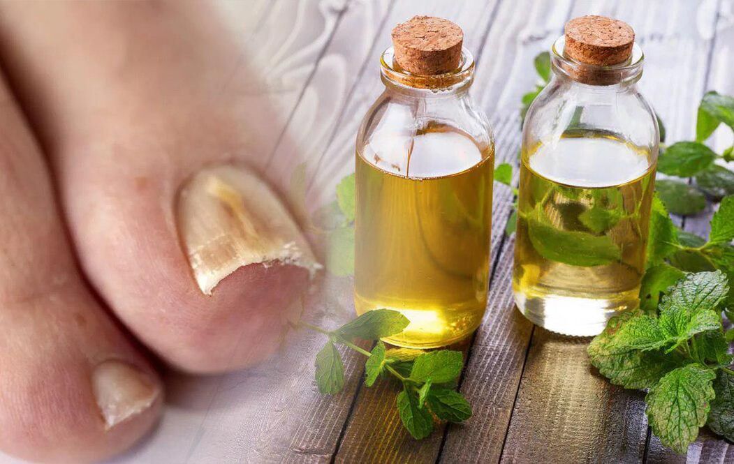 vinagre para fungos nas unhas
