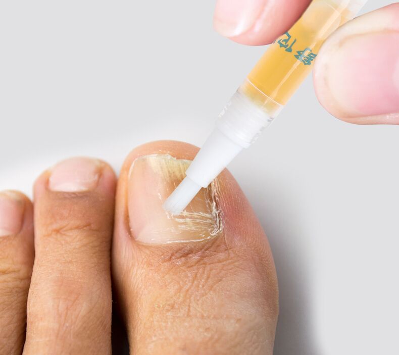 líquido contra fungo nas unhas