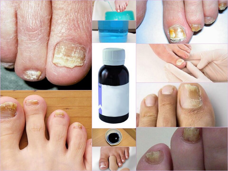 medicamentos para fungos nas unhas