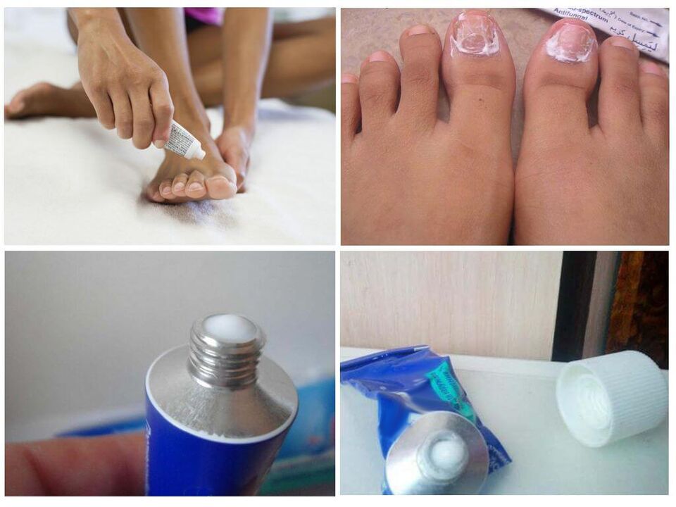 preparações farmacêuticas eficazes contra fungos nas unhas