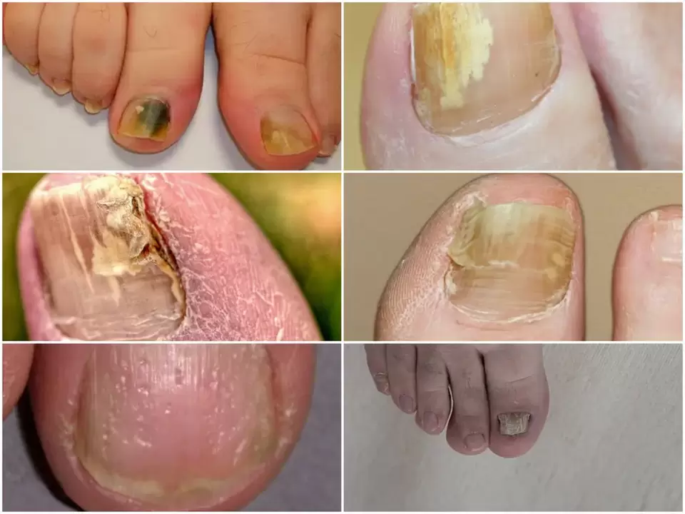 Sintomas de onicomicose - alterações na cor e estrutura das unhas