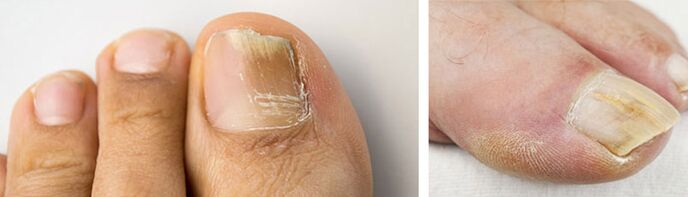 foto de uma infecção fúngica na unha do dedão do pé