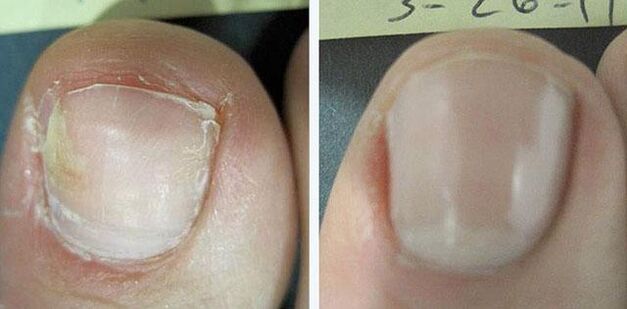 antes e depois do tratamento de fungos nas unhas
