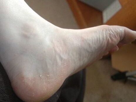 descamação do pé da perna como sinal de infecção fúngica