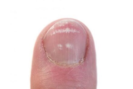 o estágio inicial da infecção do fungo das unhas