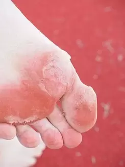 sintomas de fungo no pé